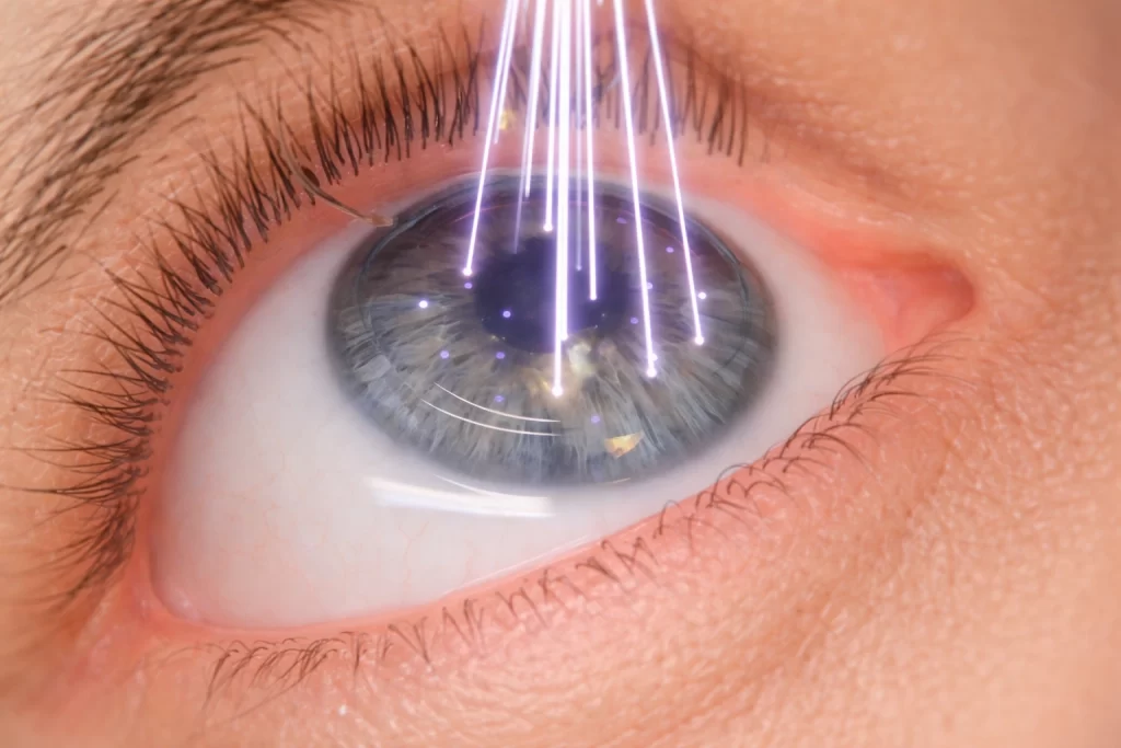 Common Myths About LASIK