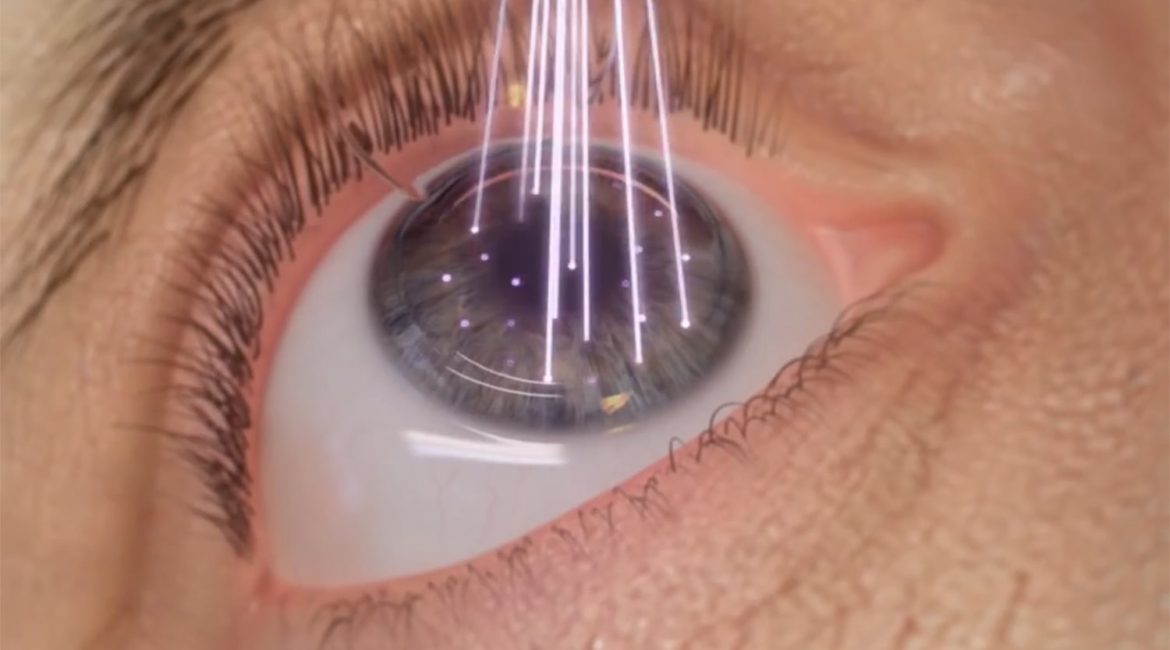 Everything About Lasik