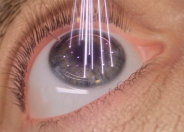 Everything About Lasik