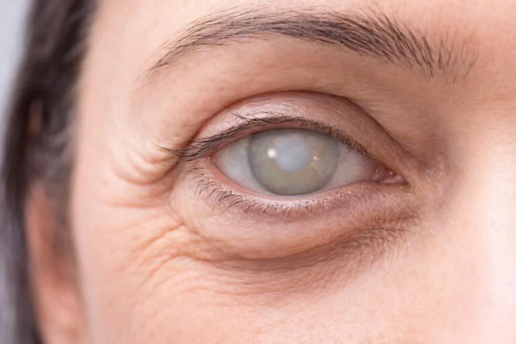 مرض عدسة العين المعتمة