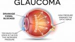 Glaucoma Treatment