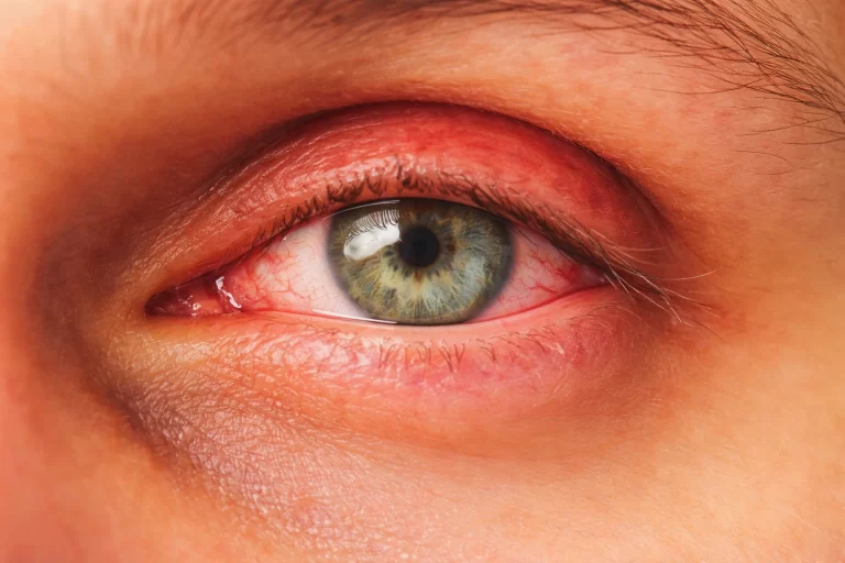 Vitreoretinal Diseases