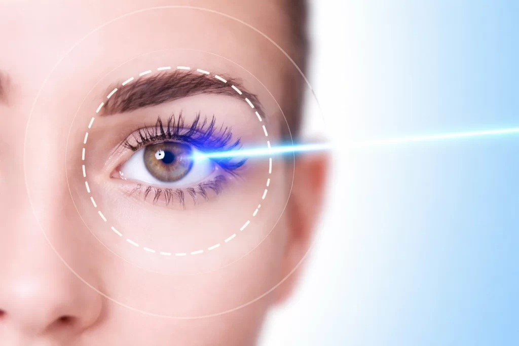 عملية الليزك