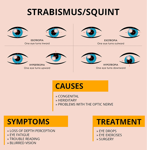 Best Squint & Pediatric Eye Consultation | Eye Clinic For Children ...