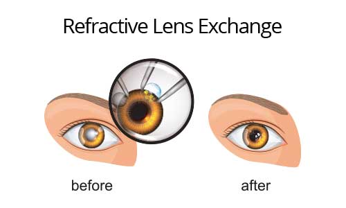 Refractive Lens Exchange Surgery Dubai