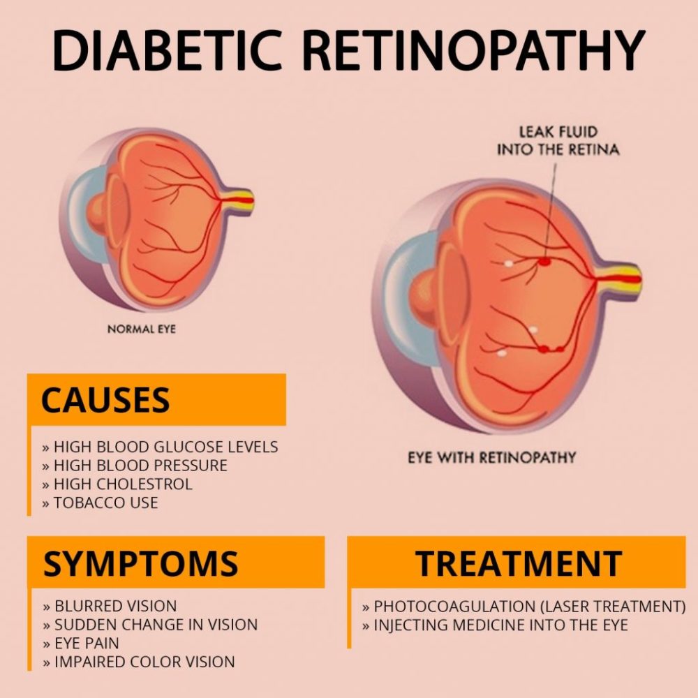 Best Diabetic Eye Clinic In Dubai 