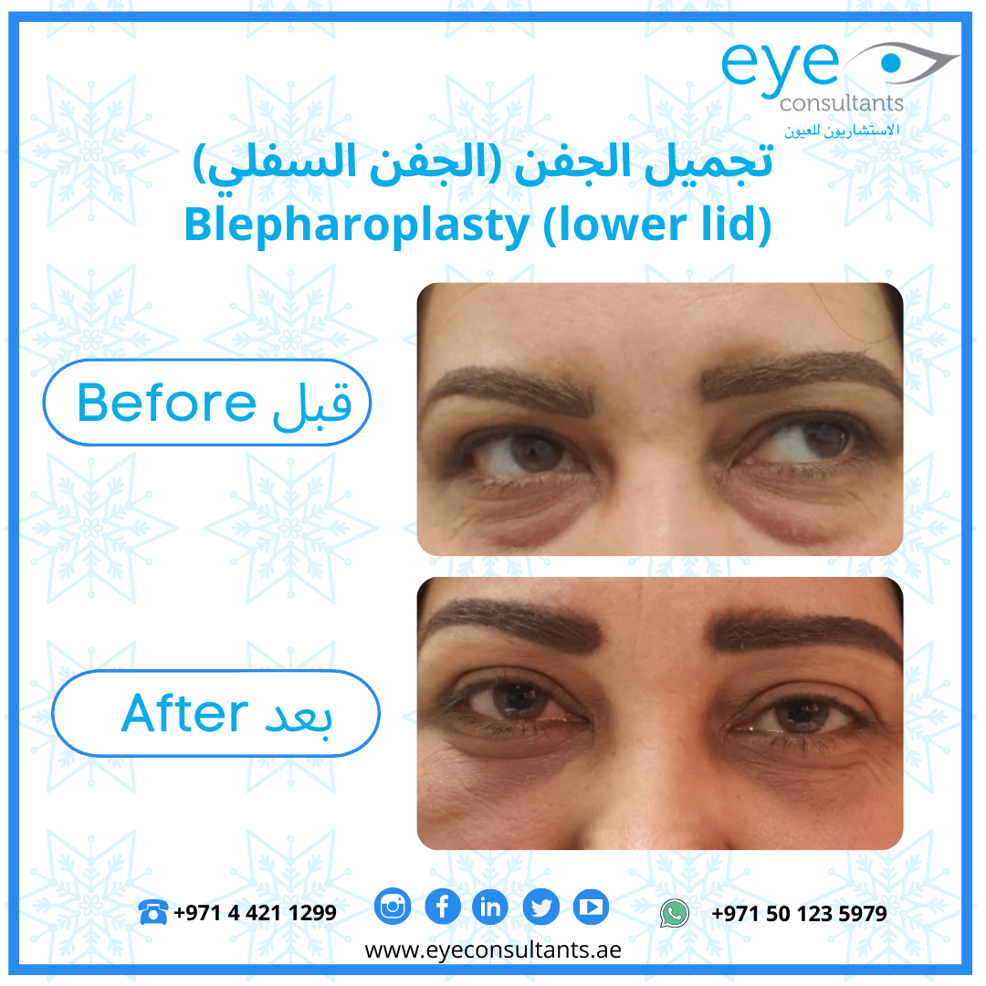 Best Oculoplastic Surgeon In Dubai | Blepharoplasty