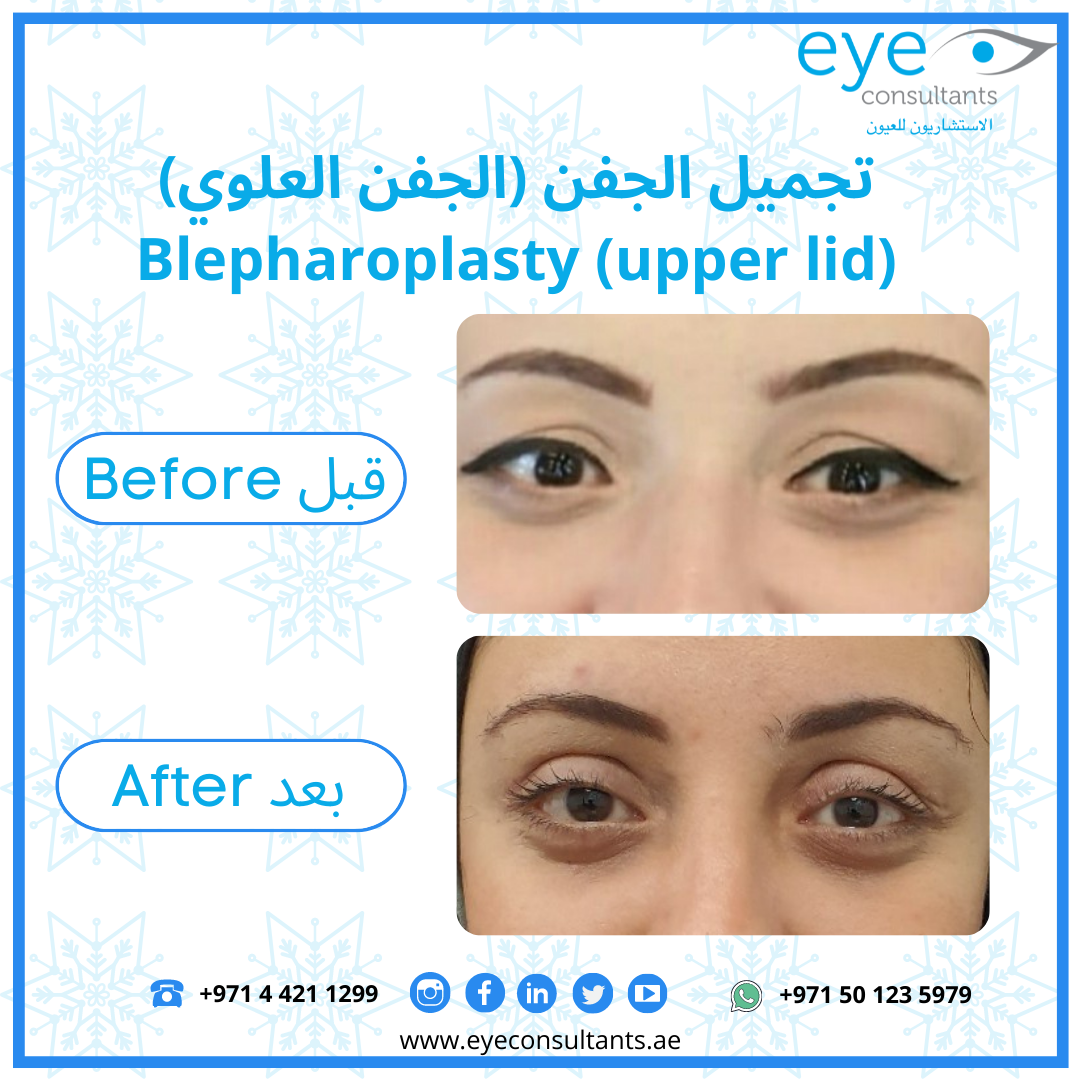 Best Oculoplastic Surgeon in Dubai Blepharoplasty
