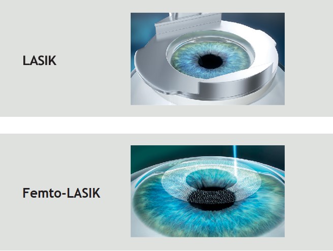 What you should know about LASIK Vs Femto-LASIK - Eye Consultants