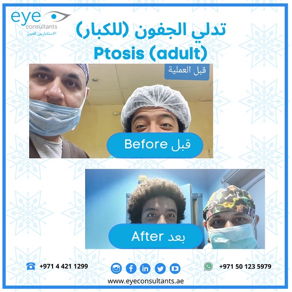 19 Oculoplasty Before and After