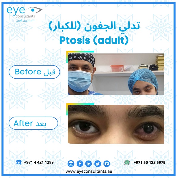 20 Oculoplasty Before and After
