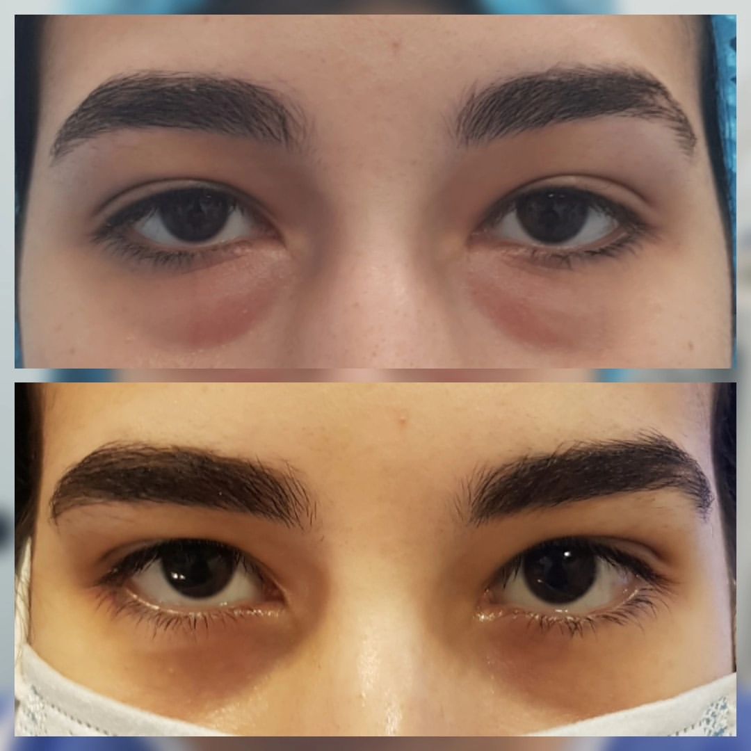 Blepharoplasty 01