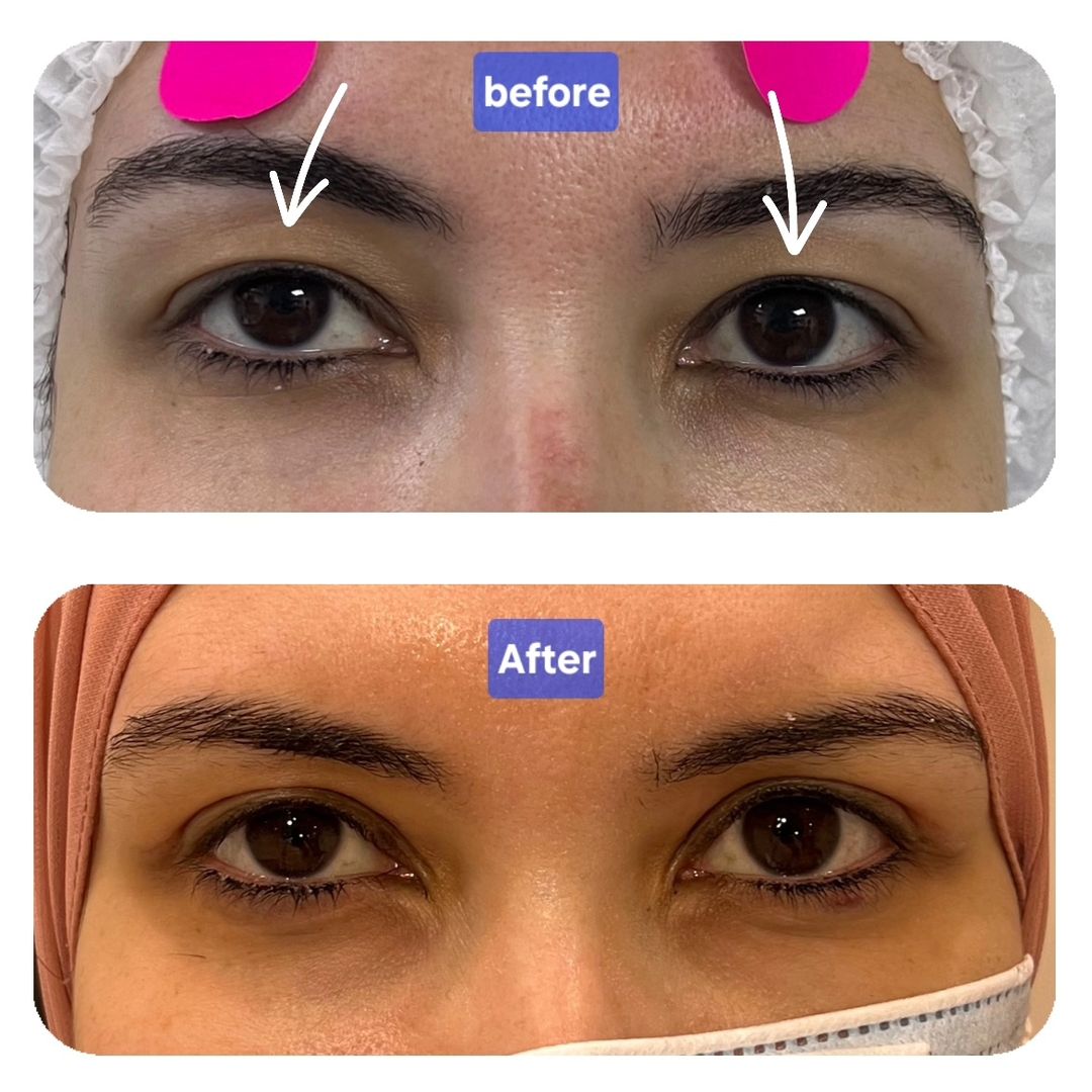 Blepharoplasty 02