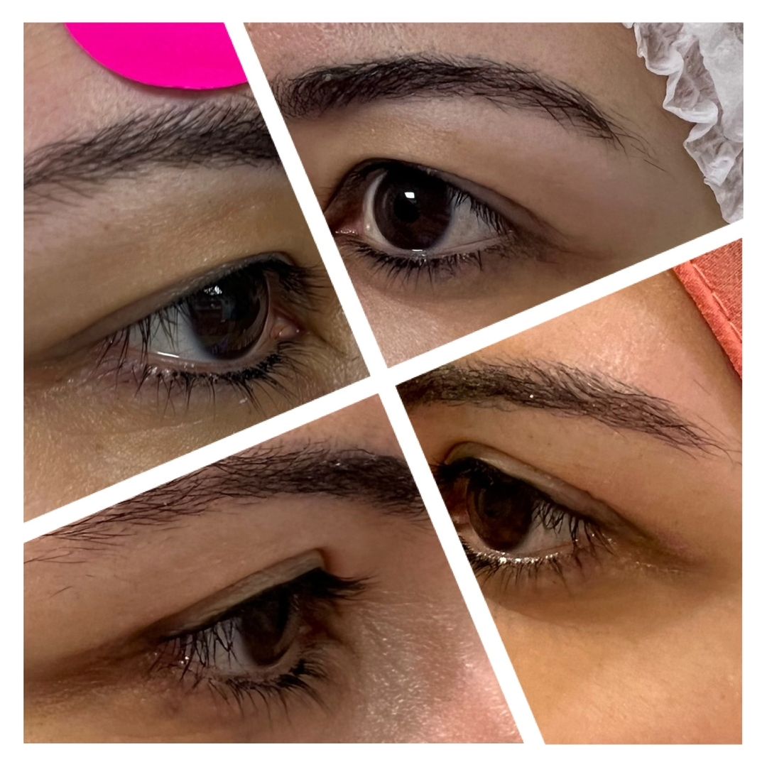 Blepharoplasty 03