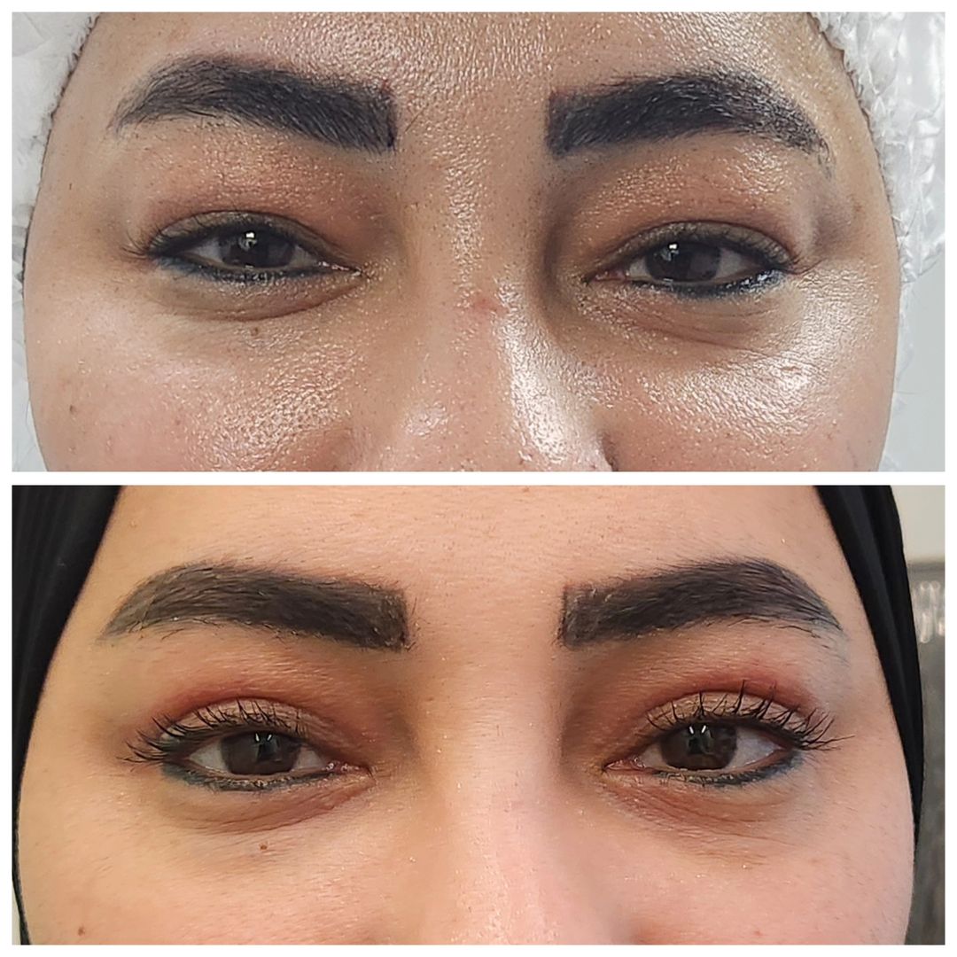 Blepharoplasty 04