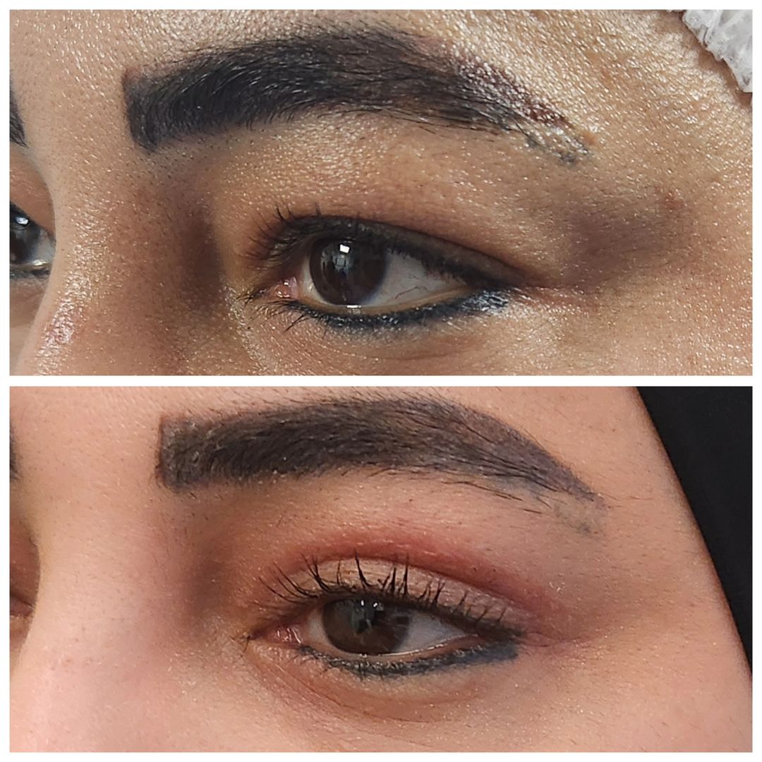 Blepharoplasty 05