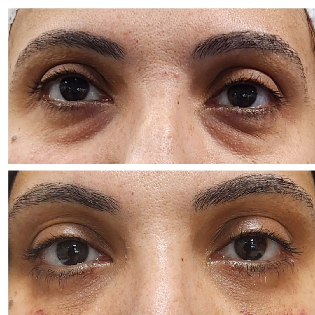 Blepharoplasty 07