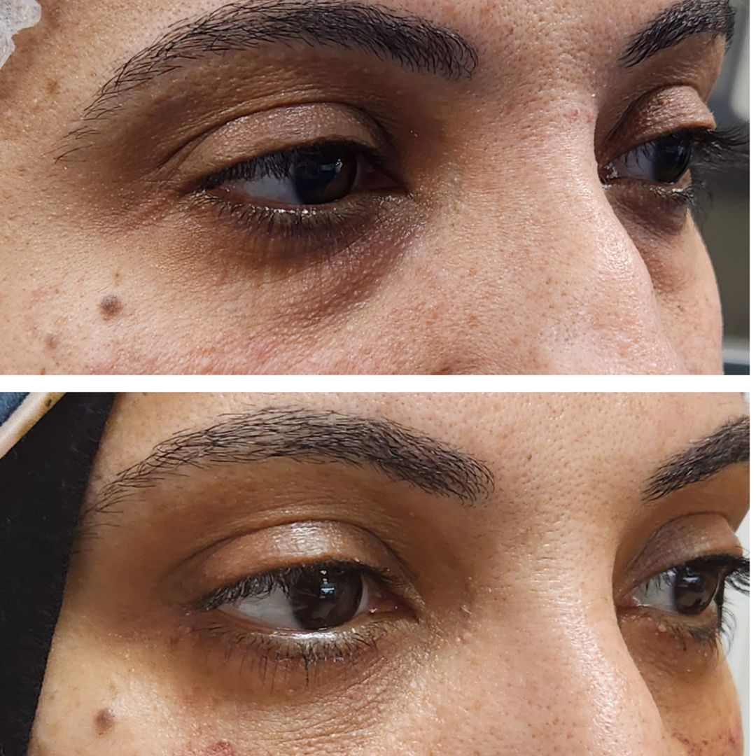 Blepharoplasty 08