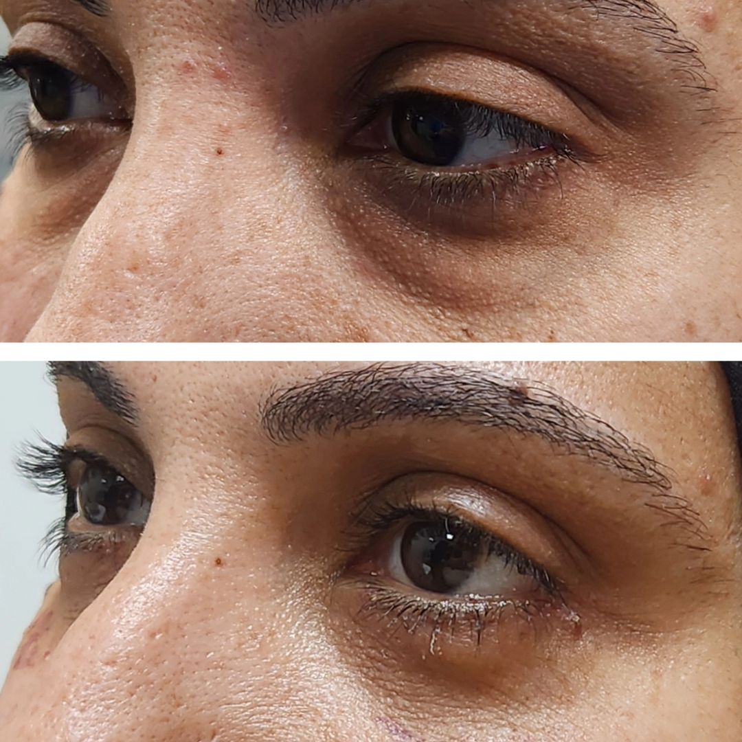 Blepharoplasty 09