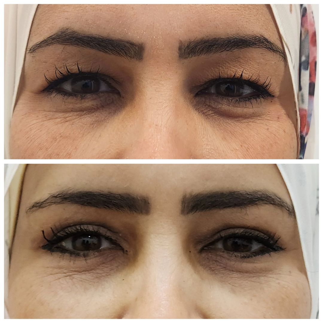 Blepharoplasty 10