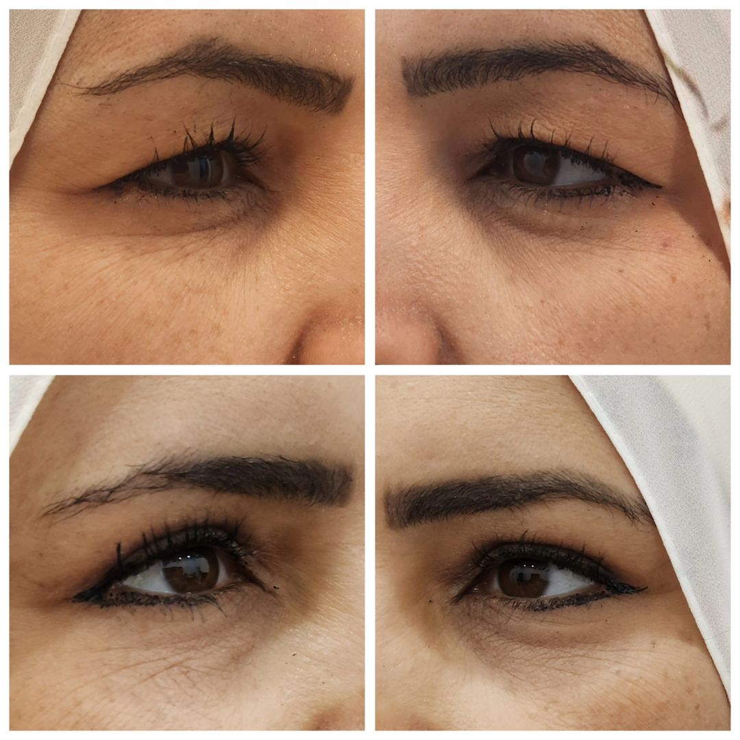 Blepharoplasty 11