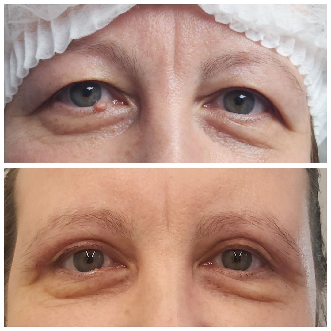 Blepharoplasty 12