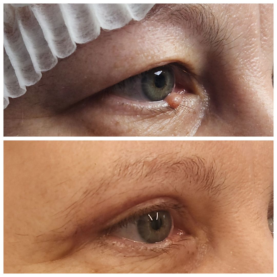 Blepharoplasty 13