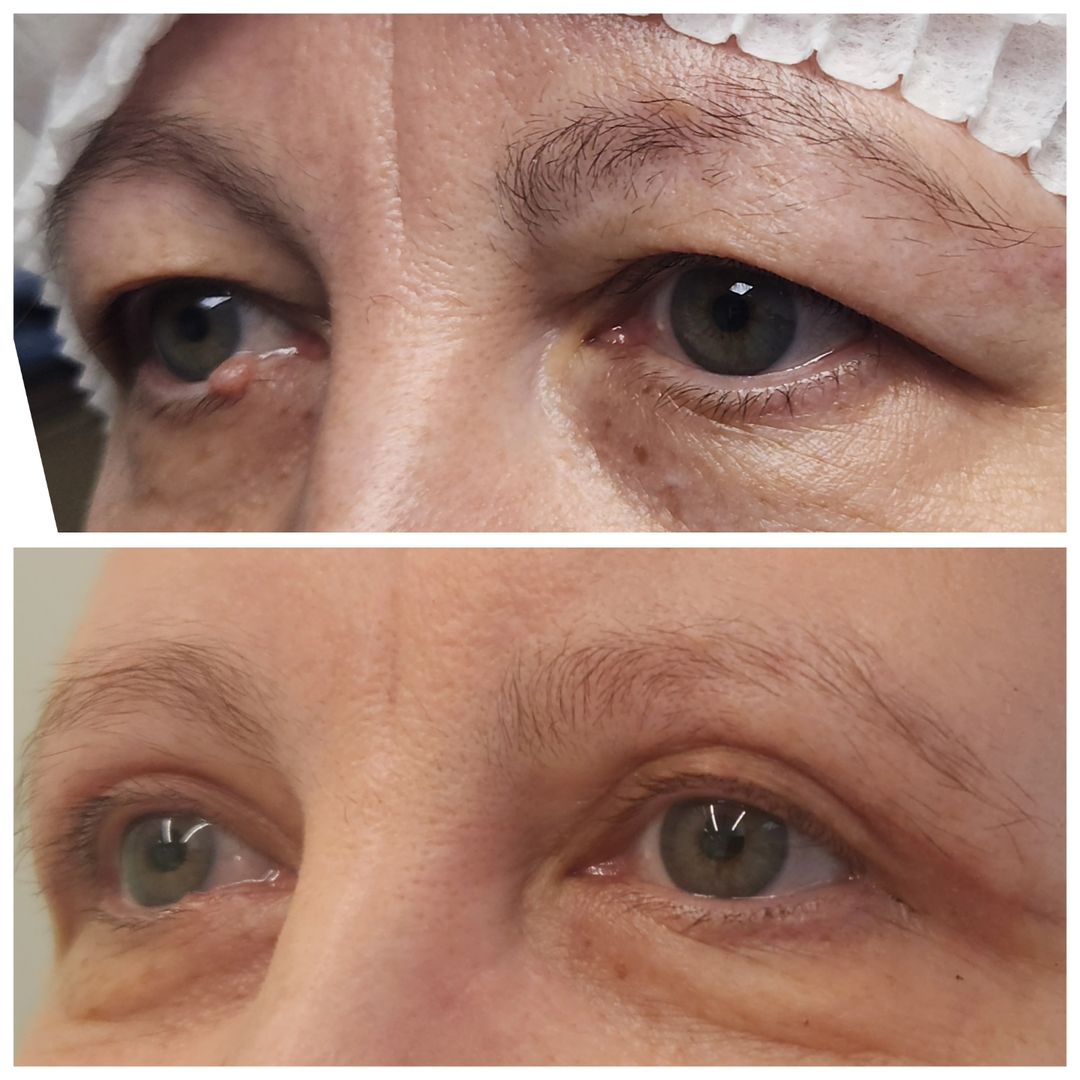 Blepharoplasty 14