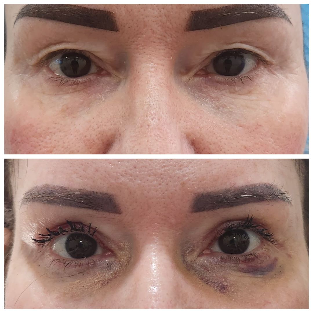 Blepharoplasty 15