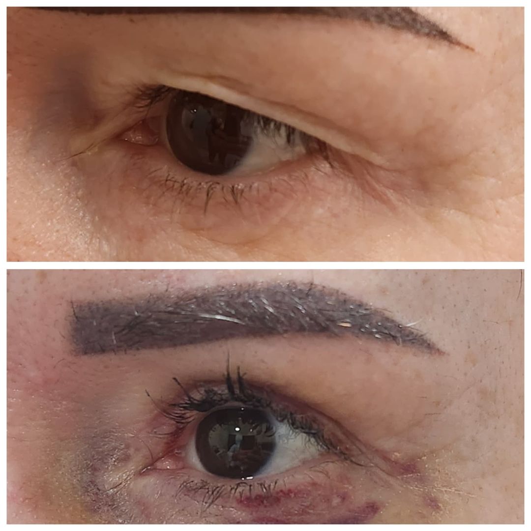 Blepharoplasty 17