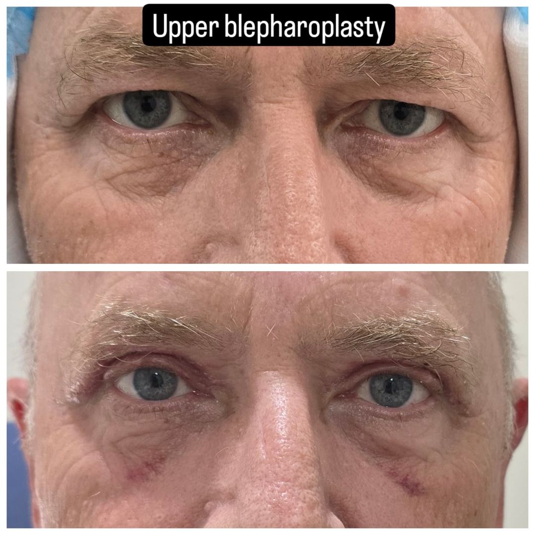 Blepharoplasty 18