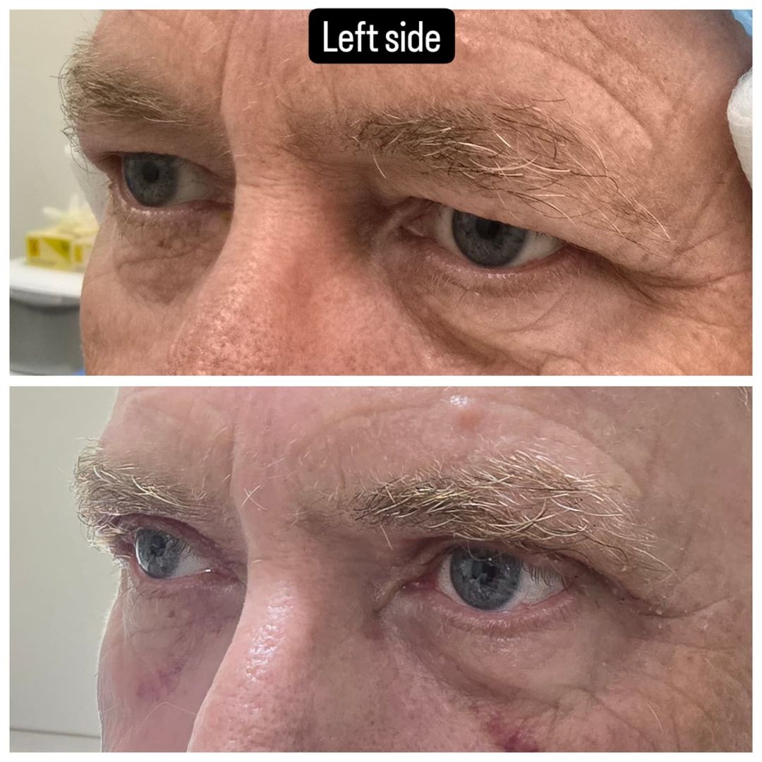 Blepharoplasty 20