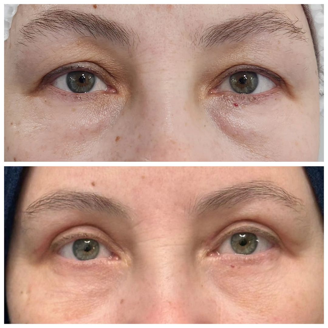 Blepharoplasty 21