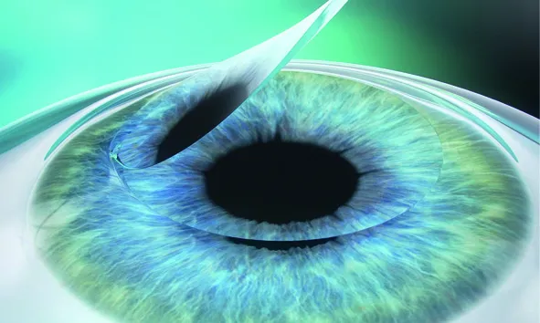 femtolasik-step-3_11zon