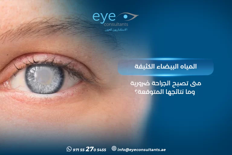 المياه البيضاء الكثيفة