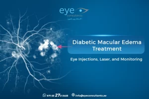 Diabetic Macular Edema Treatment – Eye Injections, Laser, and Monitoring