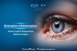 Entropion vs Ectropion: When Eyelid Malposition Needs Surgery