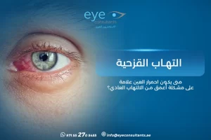 التهاب القزحية – متى يكون احمرار العين علامة على مشكلة أعمق من الالتهاب العادي؟