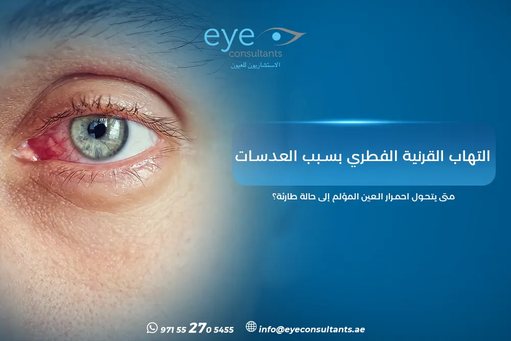 التهاب القرنية الفطري بسبب العدسات
