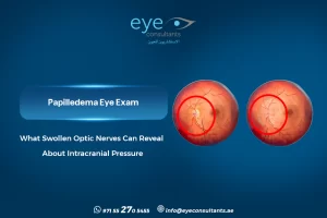 Papilledema Eye Exam – What Swollen Optic Nerves Can Reveal About Intracranial Pressure