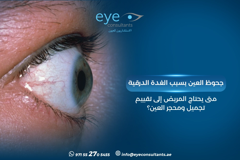 جحوظ العين بسبب الغدة الدرقية